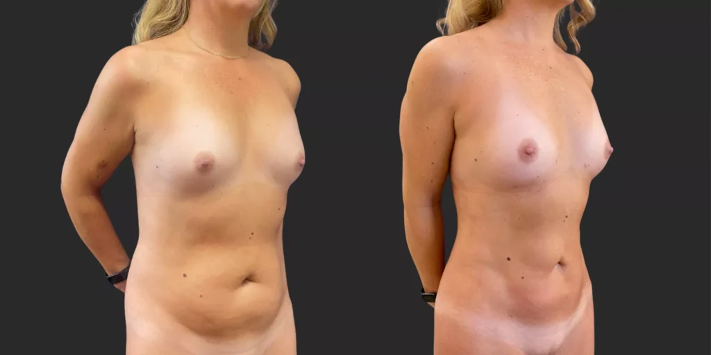 360 Lipo with Fat Transfer to Breasts #027, before and after photo, view 2