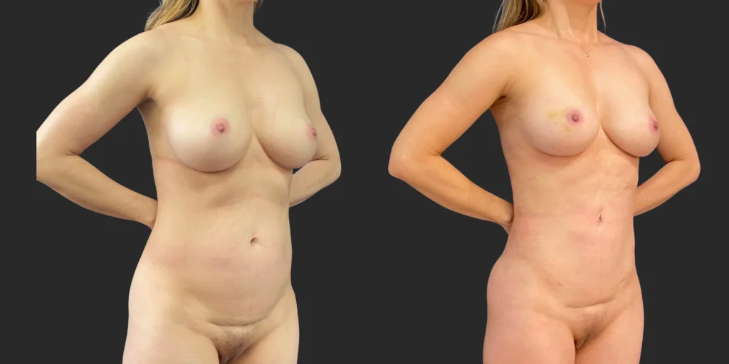 360 Lipo #017, before and after photo, view 2