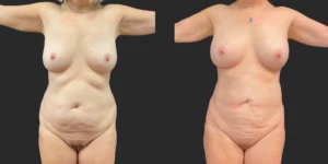 360 lipo plus upper arms #025, before and after photo