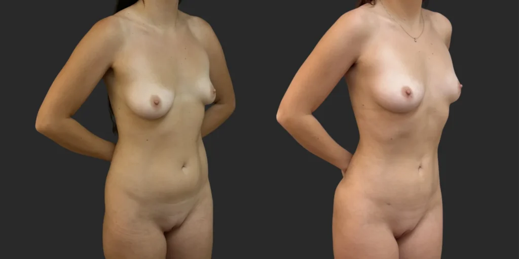 360 Lipo #009, before and after photo, view 2