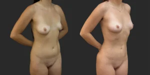 360 Lipo #009, before and after photo, view 2
