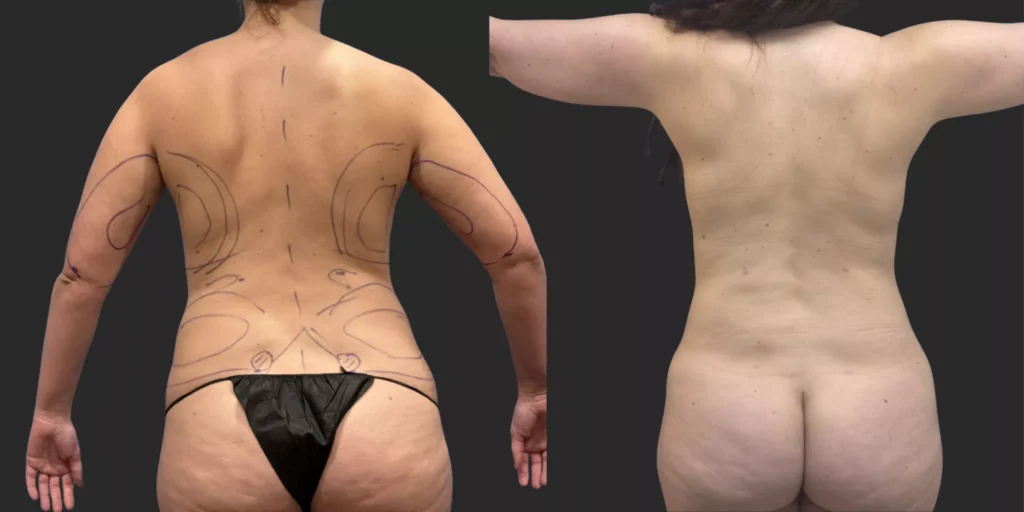 360 LBA plus Liposuction of Arms #008, before and after photo, view 3