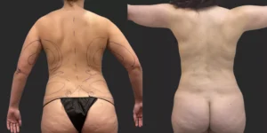 360 LBA plus Liposuction of Arms #008, before and after photo, view 3