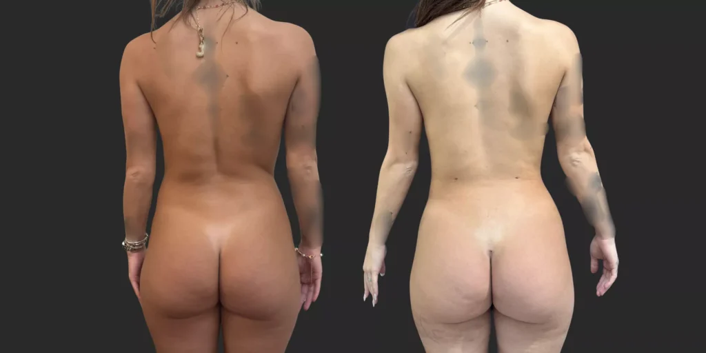 360 Lipo + Banana roll #010, before and after photo, view 3
