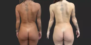 360 Lipo + Banana roll #010, before and after photo, view 3