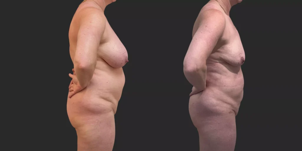 360 Lipo + Lipo of Bilateral Breasts #011, before and after photo, view 3