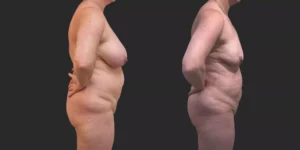 360 Lipo + Lipo of Bilateral Breasts #011, before and after photo, view 3