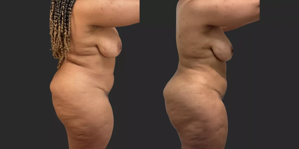 360 Lipo + Outer Thighs #012, before and after photo, view 3