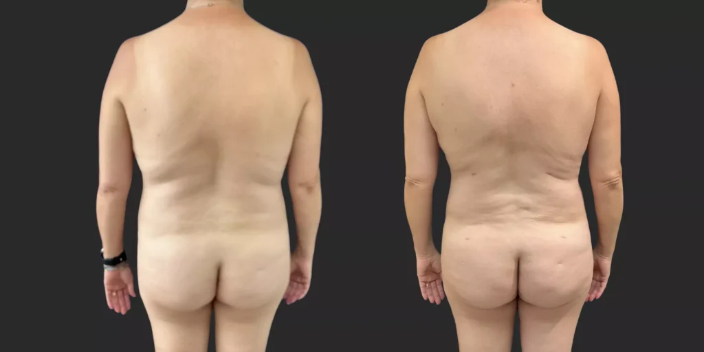 360 Lipo plus pubis #014, before and after photo, view 3