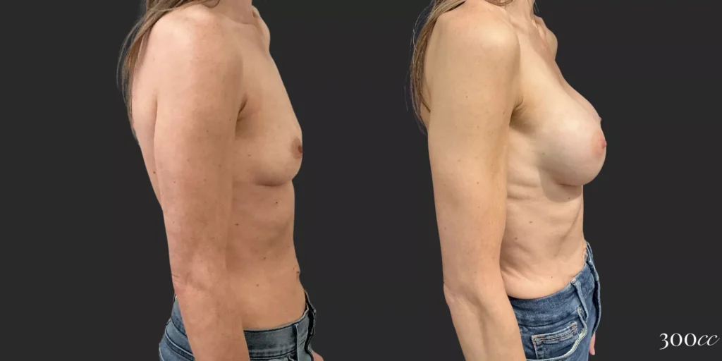 Breast Augmentation #90, before and after photo, view 3