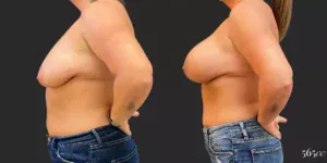 Breast Augmentation #96, before and after photo, view 3