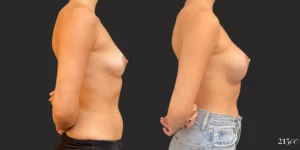 Breast Augmentation #97, before and after photo, view 3