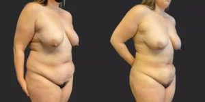 360 Lipo #019, before and after photo, view 3