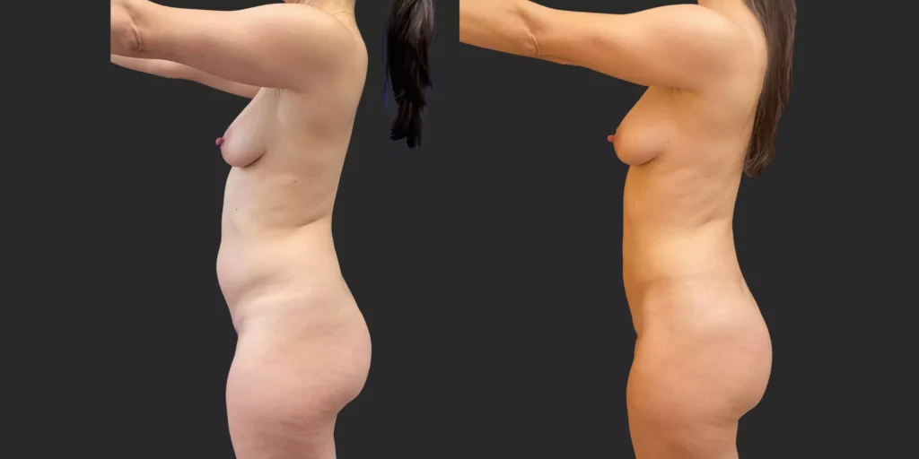 360 Lipo + Inner/Outer Thighs & Knees with Fat Transfer to Breasts #020, before and after photo, view 3