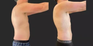360 Lipo + Lateral Chest #021, before and after photo, view 3