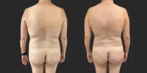 360 Lipo plus pubis #024, before and after photo, view 3