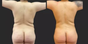 360 Lipo with Fat Transfer to Breasts #026, before and after photo, view 3
