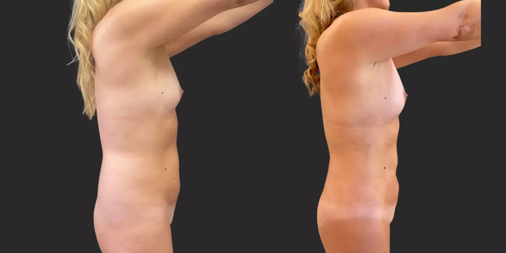 360 Lipo with Fat Transfer to Breasts #027, before and after photo, view 3