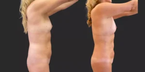 360 Lipo with Fat Transfer to Breasts #027, before and after photo, view 3