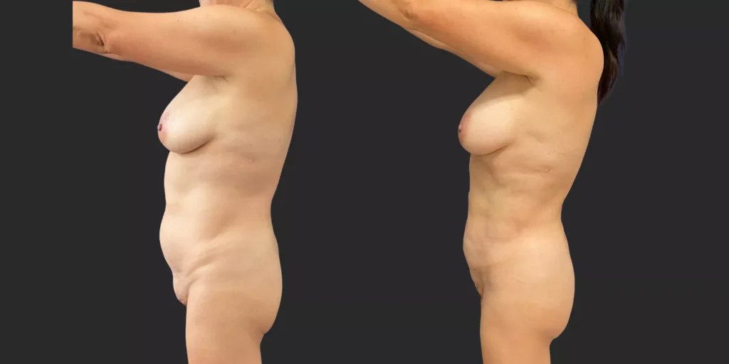 360 Lipo with Fat Transfer to Buttocks #028, before and after photo, view 3
