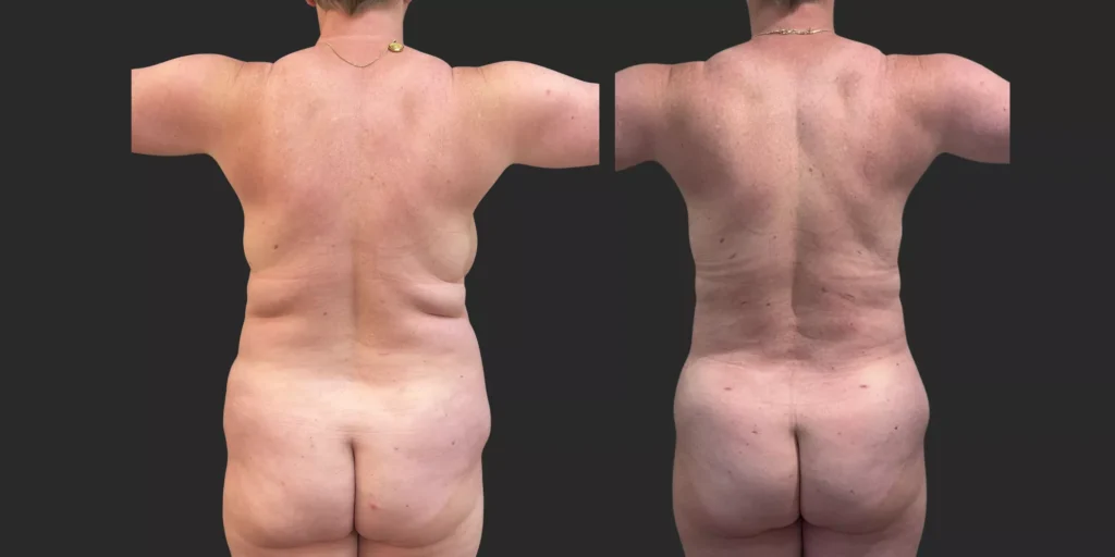 360 Lipo + Lipo of Bilateral Breasts #011, before and after photo, view 4