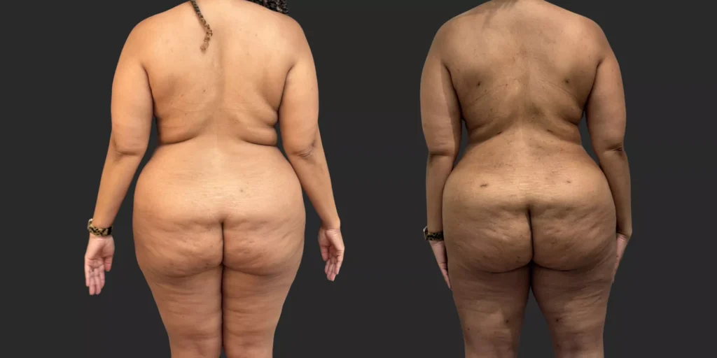 360 Lipo + Outer Thighs #012, before and after photo, view 4