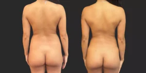 360 Liposuction with Fat Transfer to Breasts #15, before and after photo, view 4