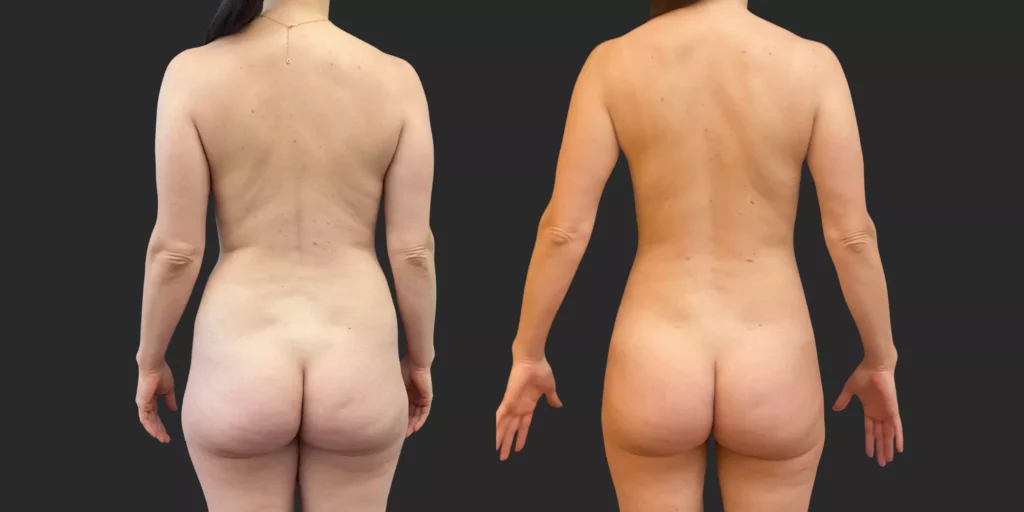 360 Lipo + Inner/Outer Thighs & Knees with Fat Transfer to Breasts #020, before and after photo, view 4