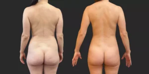 360 Lipo + Inner/Outer Thighs & Knees with Fat Transfer to Breasts #020, before and after photo, view 4