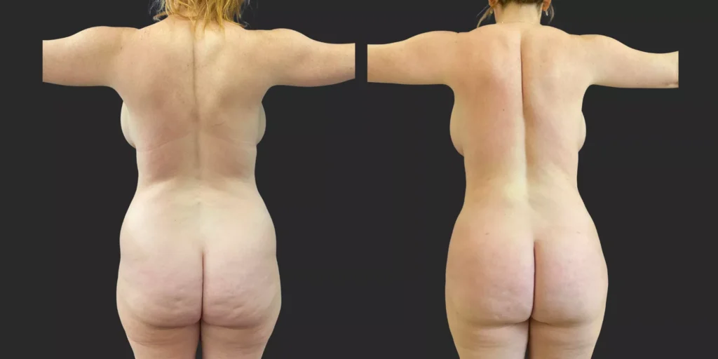 360 Lipo + Outer Thighs #022, before and after photo, view 4