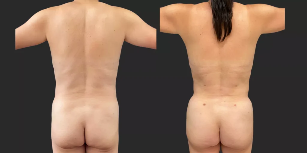360 Lipo with Fat Transfer to Buttocks #028, before and after photo, view 4
