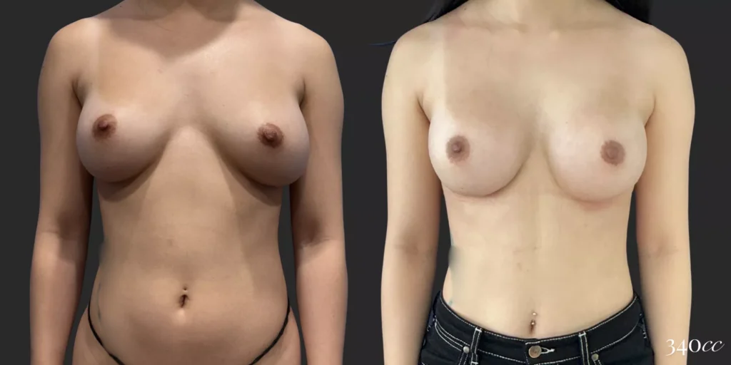 On Top® Pocket Change #11, before and after photo