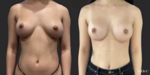 On Top® Pocket Change #11, before and after photo