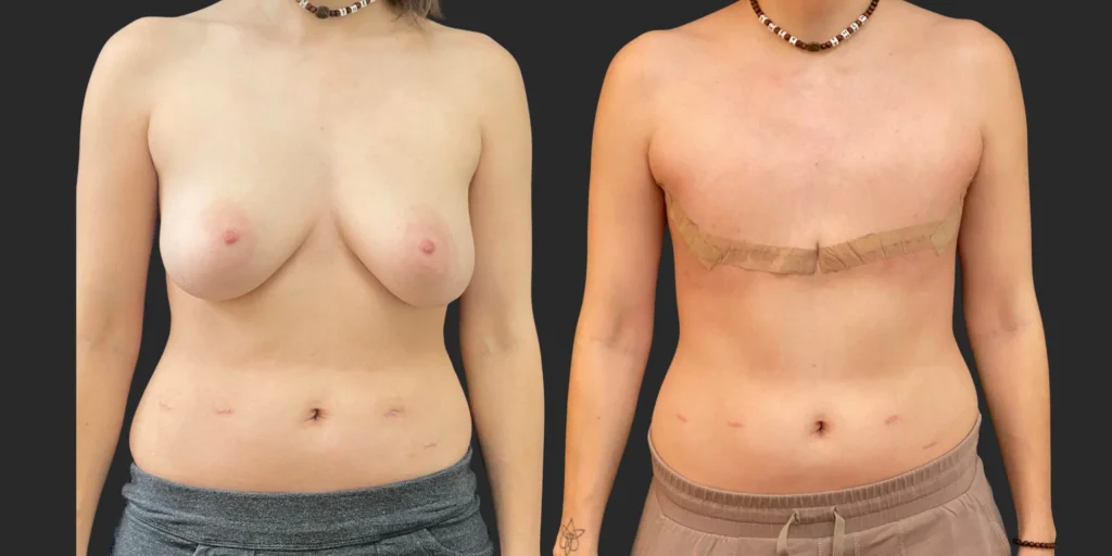 Gender Affirming Surgery #011, before and after photo