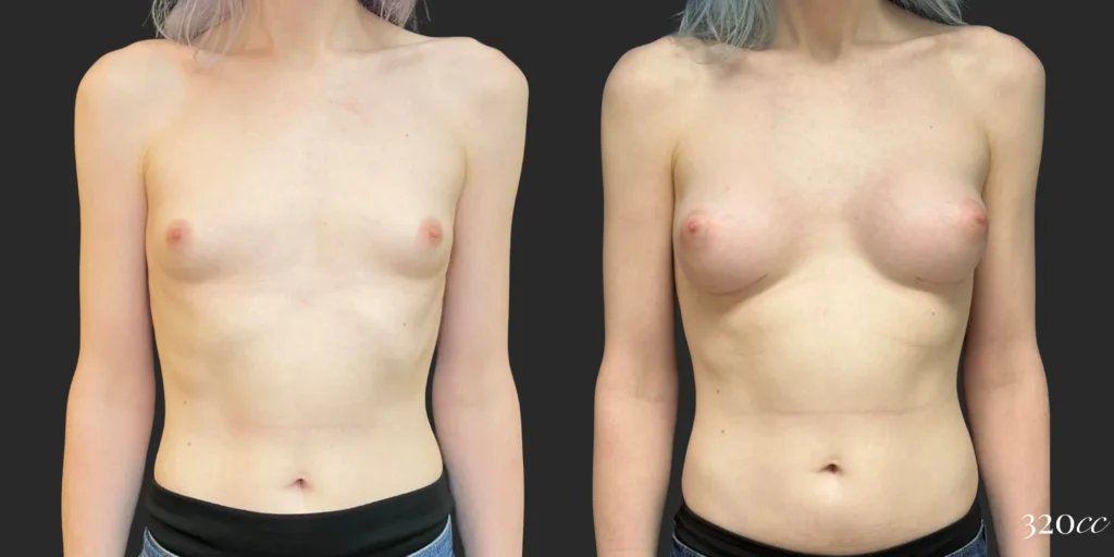 Breast Augmentation and Gender Affirming Surgery #012, before and after photo