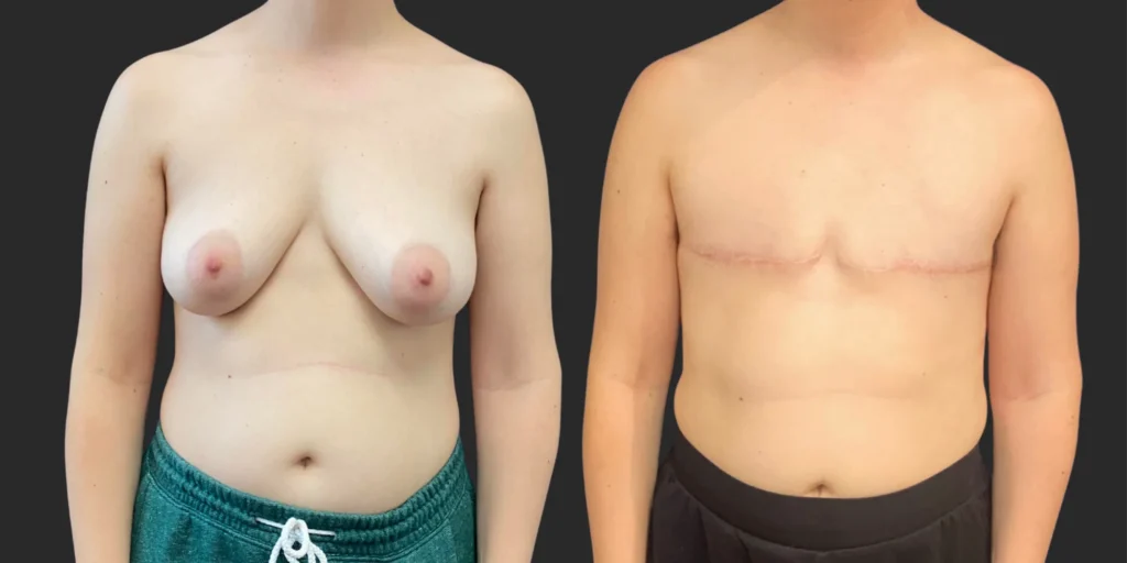 Gender Affirming Surgery #013, before and after photo