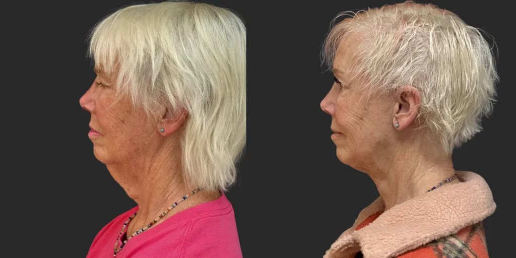 Cameo 3 Facelift #010, before and after photo, view 3