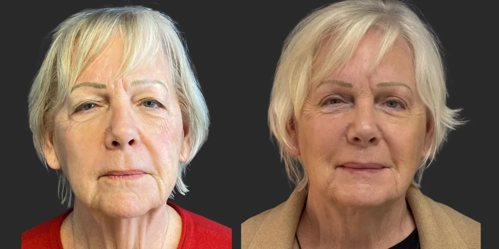 Cameo III Facelift & Bilateral Upper / Lower Blepharoplasty #013, before and after photo