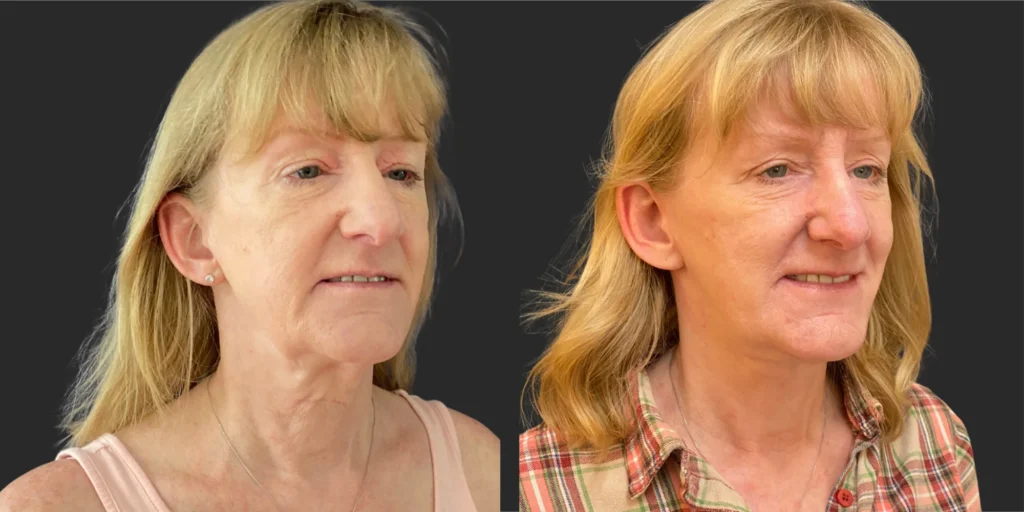 Cameo 3 Facelift #014, before and after photo