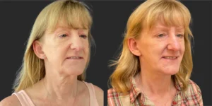Cameo 3 Facelift #014, before and after photo