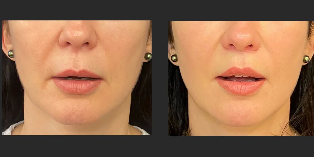 Lip Lift #016, before and after photo