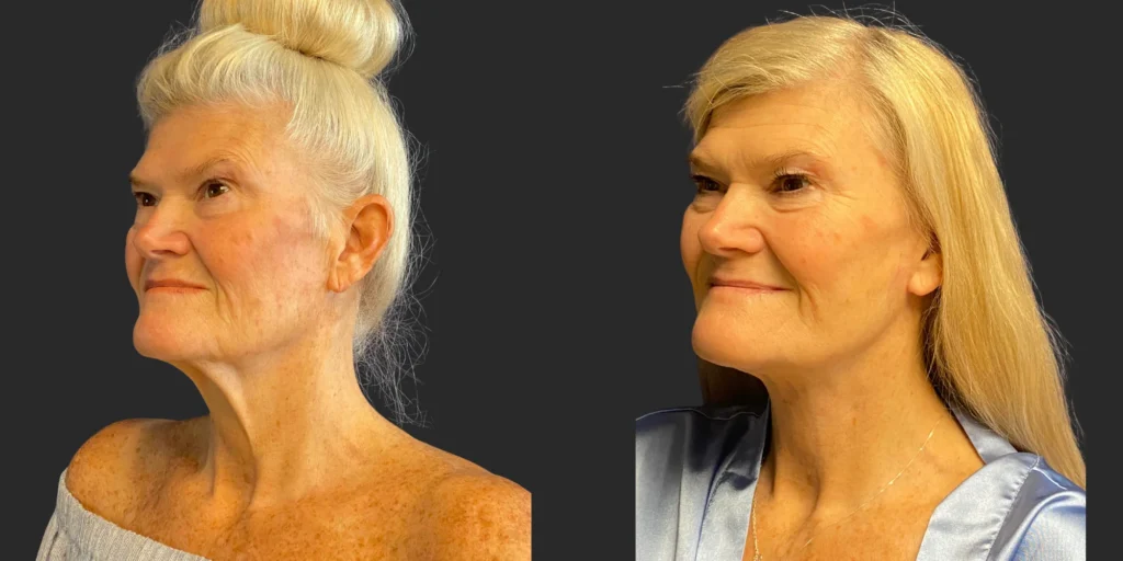 Cameo 3 Facelift #017, before and after photo