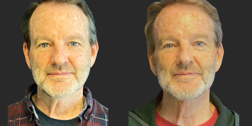 Cameo 3 Facelift #019, before and after photo