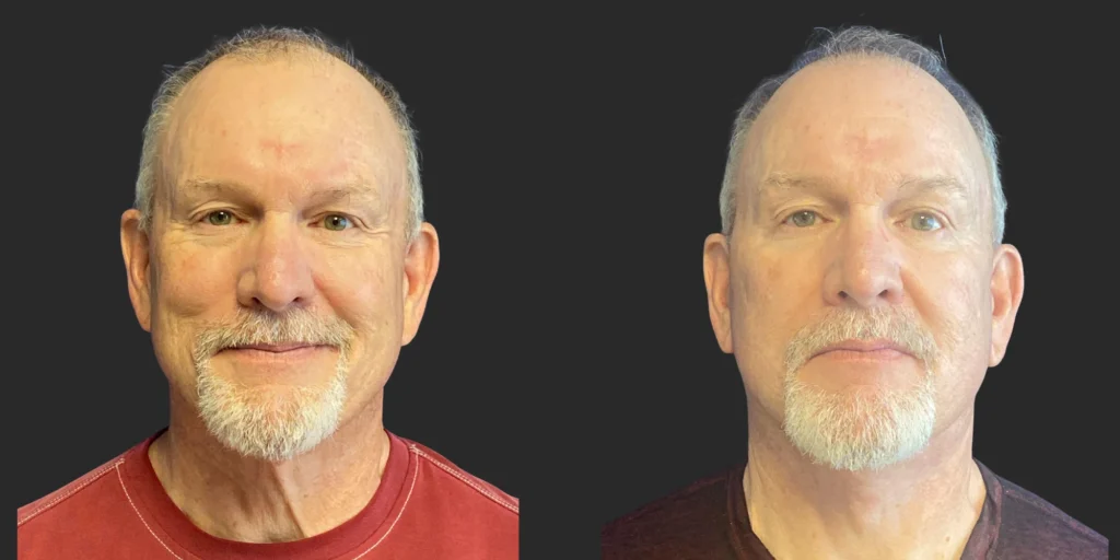 Cameo 3 Facelift #020, before and after photo