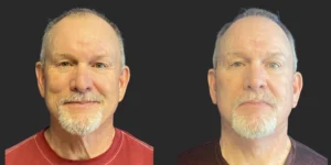 Cameo 3 Facelift #020, before and after photo