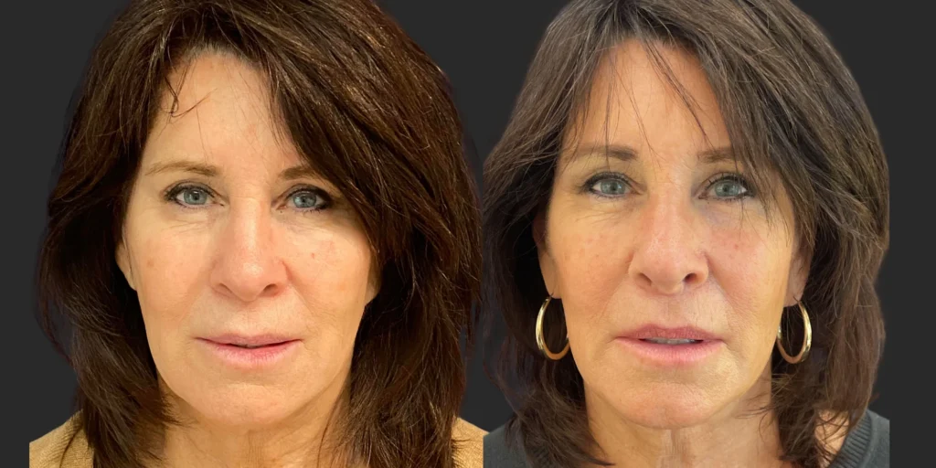 Lip Lift #021, before and after photo