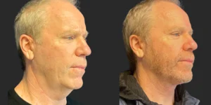 Cameo 2 Necklift #022, before and after photo, view 2