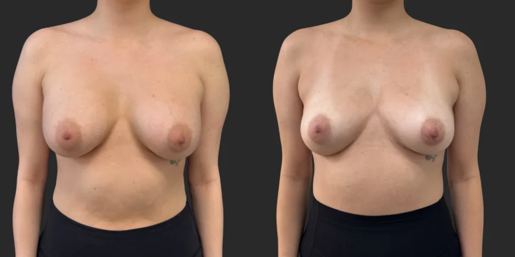 Implant Removal #010, before and after photo