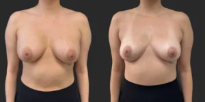 Implant Removal #010, before and after photo