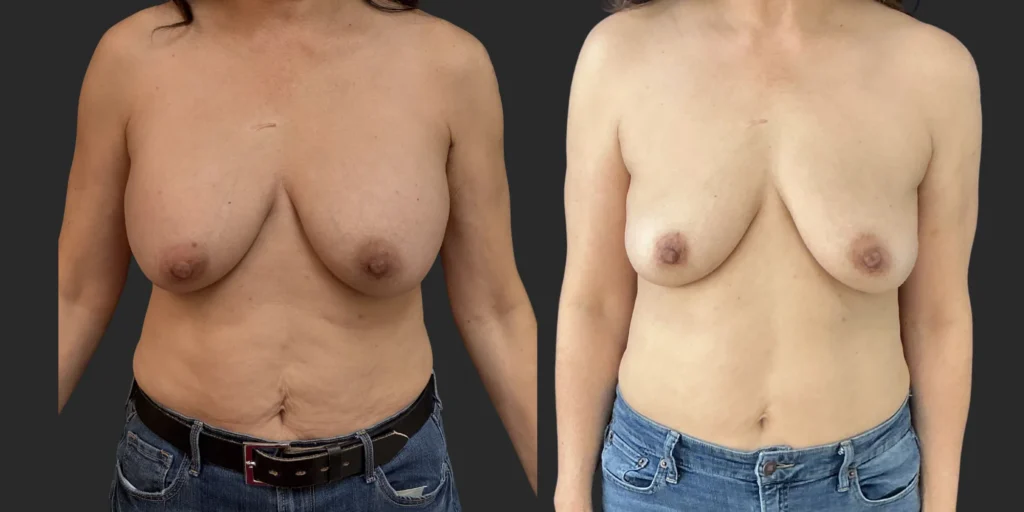 Bilateral Submuscular Implant Removal #011, before and after photo